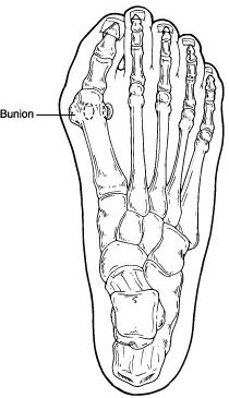 BUNIONS